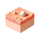 Акне